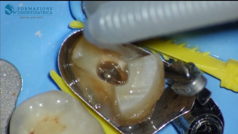 Come il perno moncone può salvare un dente devitalizzato: scopri il segreto!